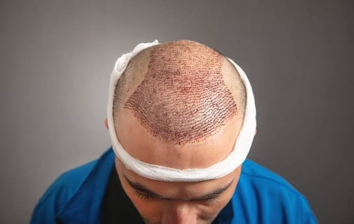 Hair transplant